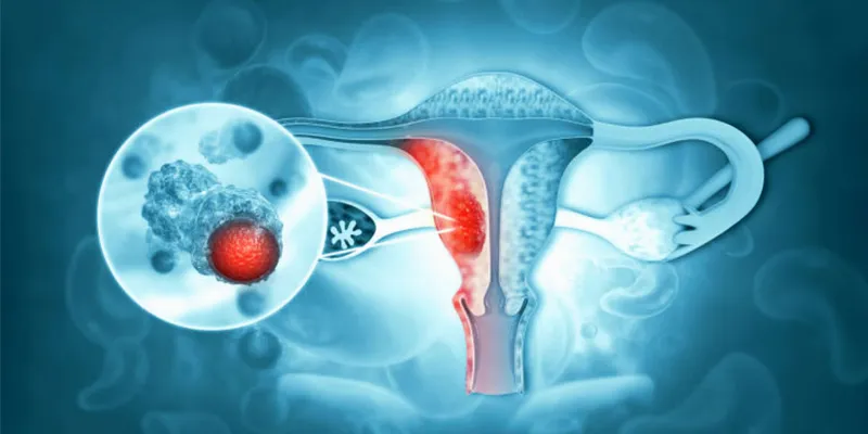 New Study Uncovers Hidden Disease in 42% of Ovarian Cancer Patients in Remission