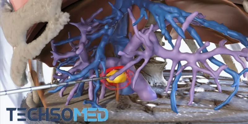 BioTrace: First FDA-Cleared Ultrasound Software for Liver Tumor Response Prediction