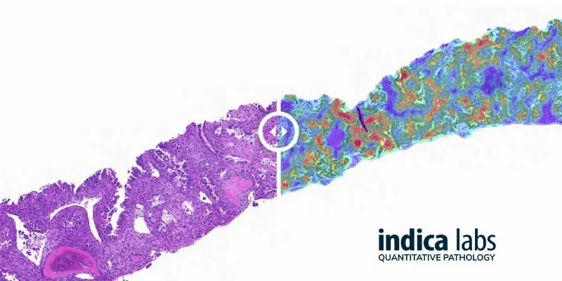 Transforming Tumor Analysis: LM AI Tool Enhances Lung Cancer Diagnostic Workflows
