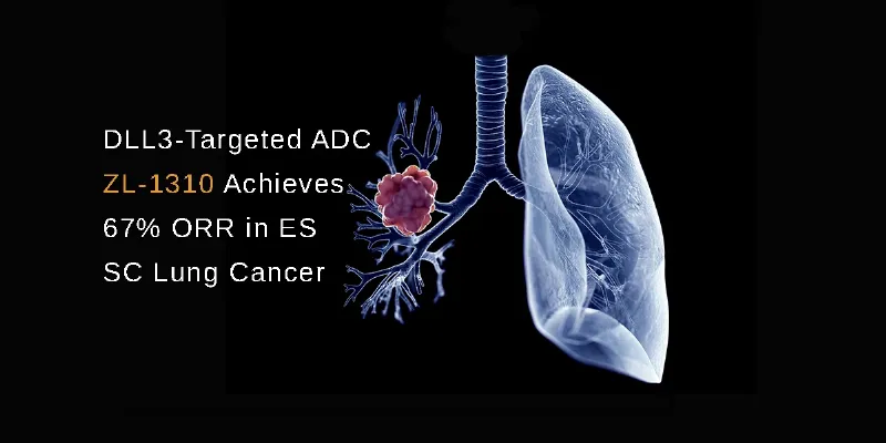 Targeted ADC ZL-1310 Shows Promising 67% ORR in Heavily Pretreated ES-SC Lung Cancer