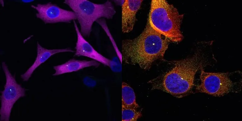 Targeting eIF2A to Halt Melanoma: Study Reveals Key Driver of Cancer Cell Migration