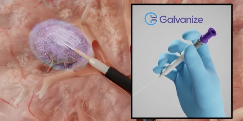 First Patient Enrolled for Aliya® PEF Tumor Ablation of Lung/Liver Soft-Tissue Lesions