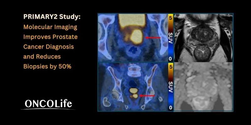 PSMA PET/CT May Transform Prostate Cancer Diagnosis and Reduce Biopsies by 50%