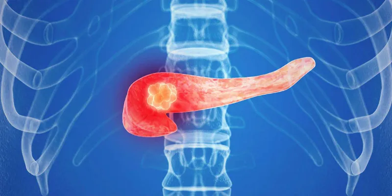 High Insulin Levels in Diabetes Increase Risk of Pancreatic Cancer